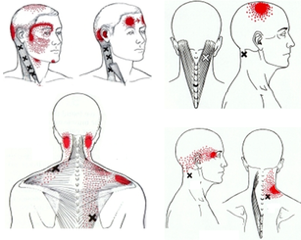 Myofasciale therapie Kine Move te Lokeren